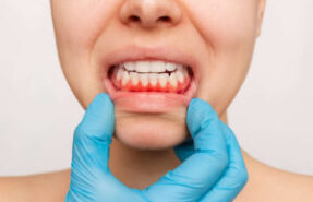 gum-inflammation-young-womans-face-with-doctors-hand-blue-glove-showing-red-bleeding-gums-300x200